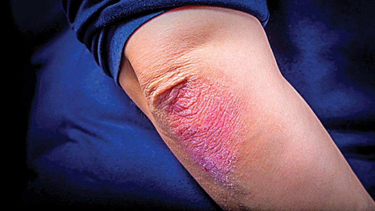 Psoriasis Patient Shares Pictures to Educate People