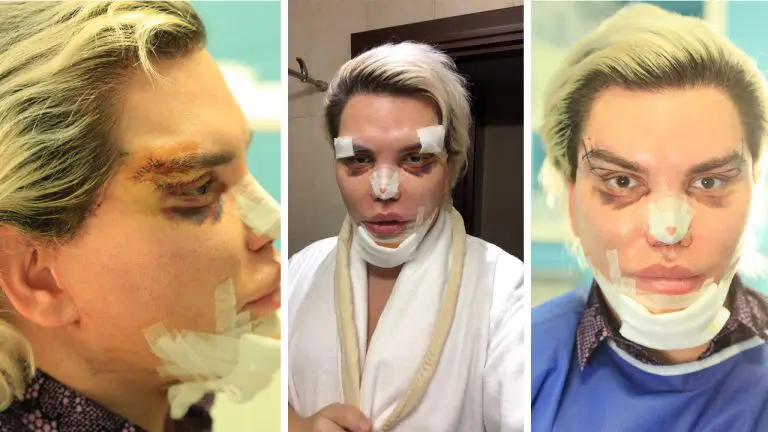 Rodrigo Alves to undergo surgery for the 43rd time