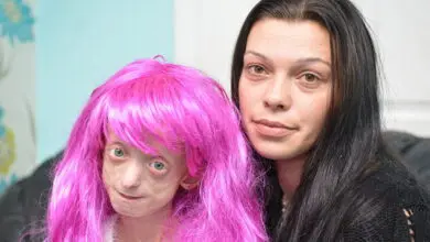 Teacher Reprimands Child with Progeria for Wearing Bright Pink Wig