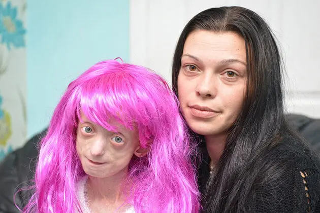 Teacher Reprimands Child with Progeria for Wearing Bright Pink Wig