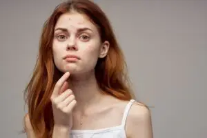 Acne breakouts - Too Much Sugar is bad